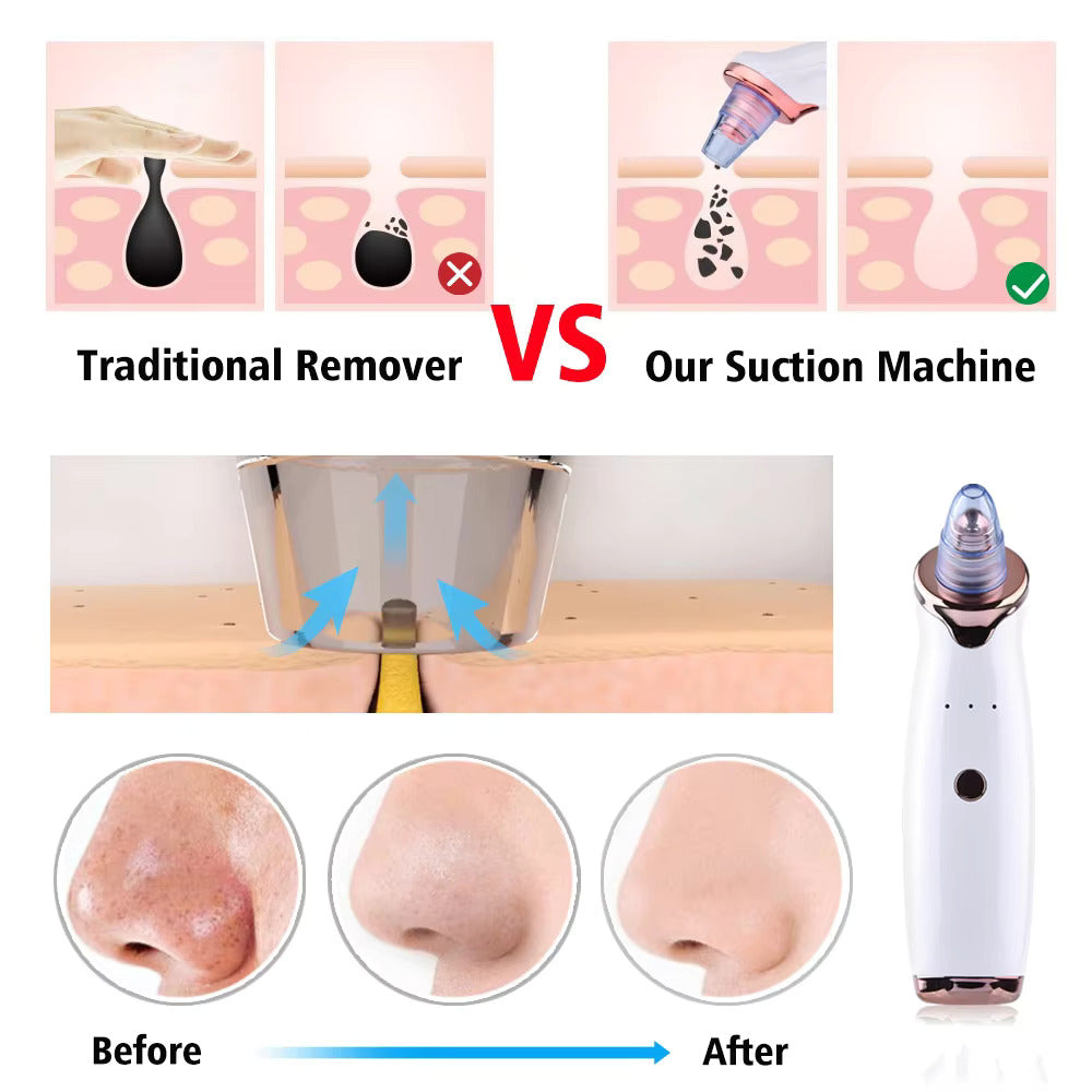 Blackhead and Whitehead Remover - For Instant Clear Face